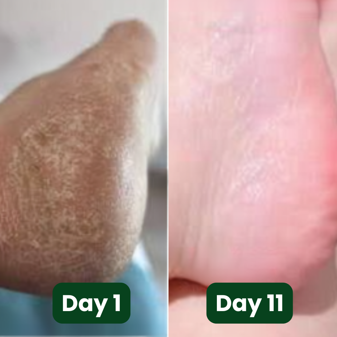 Murvano Antifungal Soap