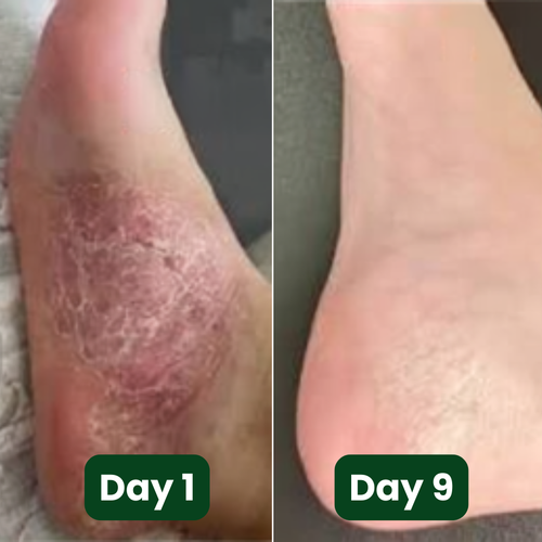 Murvano Antifungal Soap