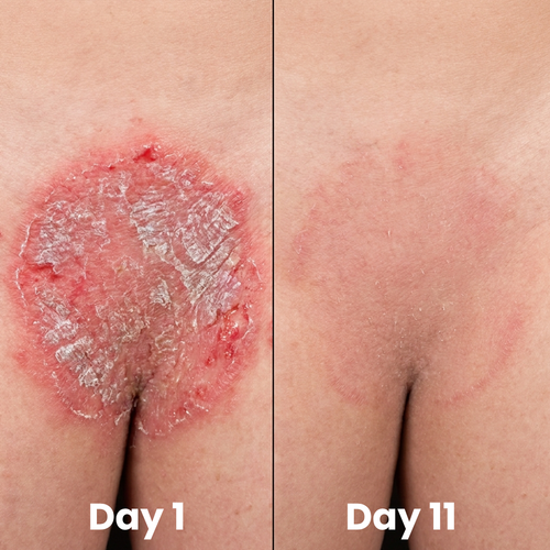 Murvano Antifungal Soap
