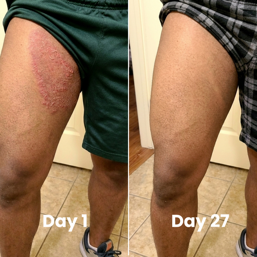 Murvano Antifungal Soap